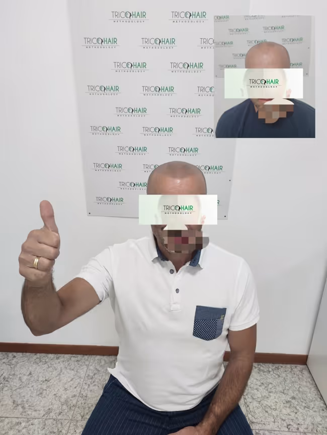 I risultati ottenuti dalla Tricopigmentazione Bari - Tricohari Methodology