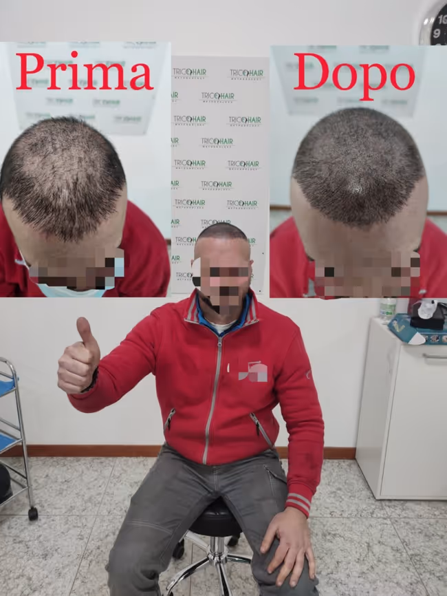 I risultati ottenuti dalla Tricopigmentazione Bari - Tricohari Methodology