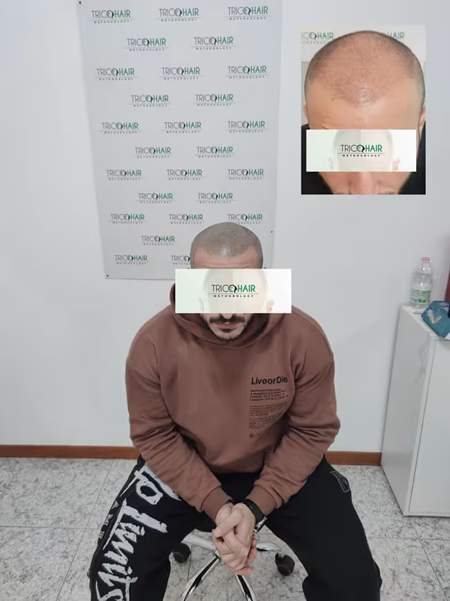 I risultati ottenuti dalla Tricopigmentazione Bari - Tricohari Methodology