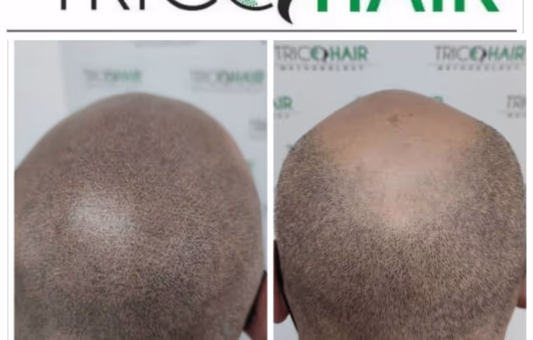 I risultati ottenuti dalla Tricopigmentazione Bari - Tricohari Methodology