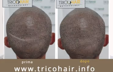 I risultati ottenuti dalla Tricopigmentazione Bari - Tricohari Methodology